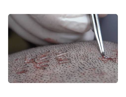 Graft Extraction